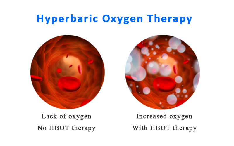 What's HBOT Therapy